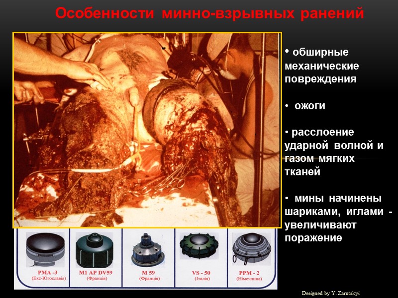 Особенности минно-взрывных ранений   обширные механические повреждения    ожоги  